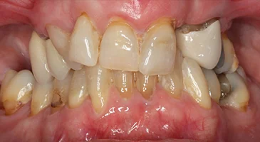 Before treatment: worn, uneven and discoloured upper front teeth