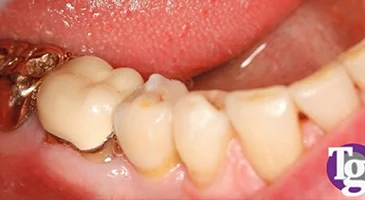 After treatment: the implant restored with a crown matching the neighbouring teeth