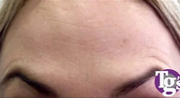 After treatment: smoother forehead skin with the lines reduced