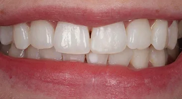 After Invisalign: straighter, evenly aligned front teeth