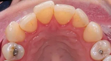Before Invisalign: occlusal view of the upper arch showing crowded, unevenly spaced teeth