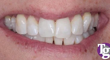 After teeth whitening: brighter upper front teeth