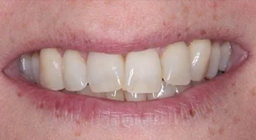 Before teeth whitening: yellowed upper front teeth