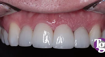After porcelain veneers: evenly shaped, uniform upper front teeth