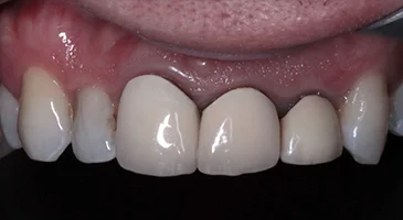 Before porcelain veneers: uneven, discoloured upper front teeth