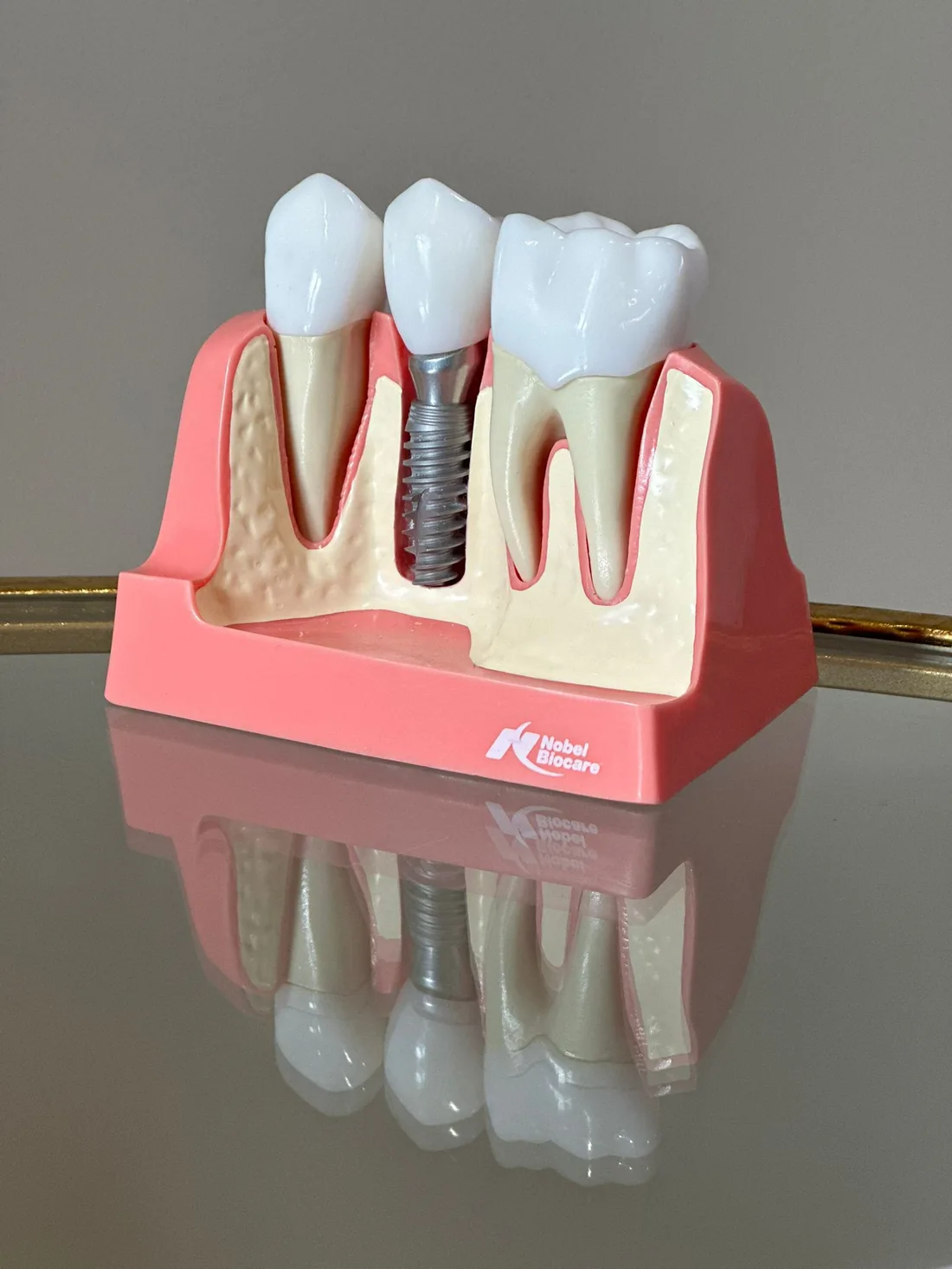 A cross-section dental model showing how an implant sits in the jaw beside natural teeth